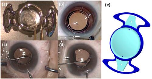 Figure 1 (A) Multicomponent intraocular lens assembly outside of eye. (B) Multicomponent intraocular lens after in the bag implantation. (C) Front optic being removed from the anterior chamber during the enhancement procedure 3 months after primary implantation using a specially designed Sinsky hook. (D) Front optic component being inserted under the base optic component bridges during the enhancement procedure 3 months after primary implantation. (E) Illustration of the multicomponent intraocular lens. Dark blue schema represents the base lens and the light blue the front lens.