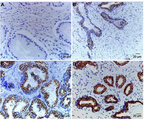 Figure 2 RRBP1 expression was detected in PCa by IHC. (A) No positive staining of RRBP1 in non-cancerous prostate tissues (Score = 0, ×400). (B) Weak staining of RRBP1 in PCa (Score = 1, ×400). (C) Moderate staining of RRBP1 in PCa (Score = 4, ×400). (D) Strong staining of RRBP1 in PCa (Score = 9, ×400).Abbreviations: RRBP1, ribosome binding protein 1; IHC, immunohistochemistry; PCa, prostate cancer.