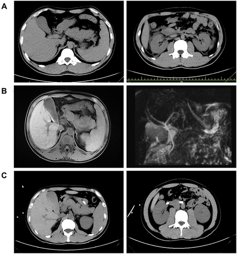 Figure 1 Abdominal CT images of the patient. (A) Abdominal CT on June 25, 2022. The pancreas was swollen with effusion around the pancreas and both kidneys. (B) An MRCP image of the patient on July 1, 2022. The pancreas is enlarged, surrounding tissues were exudation, and the gallbladder is full, cholestasis. (C) Abdominal CT on July 5, 2022. Compared with the abdominal CT images on June 25, 2022, the exudation around pancreas and bilateral kidneys was obviously improved.