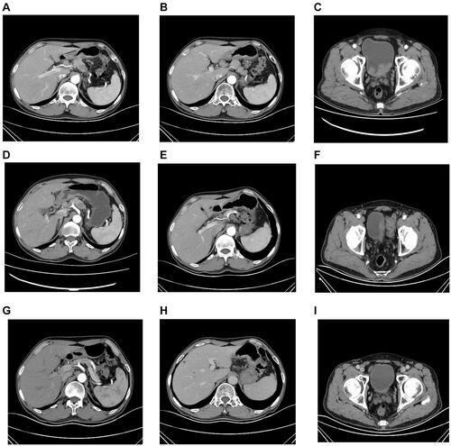 Figure 3 Abdominal CT images of the patient. (A and B) Abdominal CT images at initial diagnosis indicated multiple enlarged lymph node metastases around the stomach. (C) Abdominal CT images at initial diagnosis indicated multiple bladder tumors. (D and E) Abdominal CT images after 2 cycles of chemotherapy indicated multiple enlarged lymph node metastases around the stomach were smaller. (F) Abdominal CT images indicated new tumor in bladder and a recurrence of bladder cancer was considered. (G and H) Abdominal CT scan after 8 cycles of immunotherapy plus targeted therapy showed a significant reduction and shrinkage of metastatic lymph nodes around the stomach which suggested a partial response of the gastric cancer. (I) Abdominal CT scan showed the recrudescent bladder cancer was significantly shrunk after 8 cycles of immunotherapy plus targeted therapy.