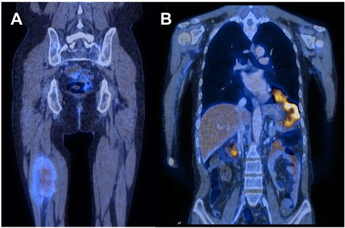 Figure 4. Patient 1, who had small bowel involvement on presentation but involvement of extra-intestinal sites on relapse. (A) Coronal image showing hypermetabolic lesion in the thigh. (B) Coronal image showing hypermetabolic lesions in stomach infiltrating through the left hemi-diaphragm to involve the left thoracic cavity.