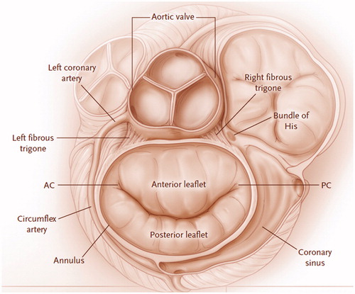 Figure 1. Mitral valve anatomy. The mitral valve comprises of the anterior and posterior leaflets, which are separated by the anterior commissure (AC) and the posterior commissure (PC). The leaflets are inserted on the circumference of the mitral annulus in continuity with the aortic annulus and the left and right fibrous trigones. mitral valve. Reprint with permission from Verma et al. [Citation9].
