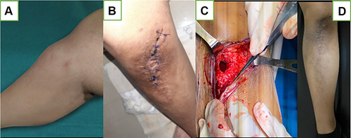 Figure 7 (A) Before Operation; (B) After 1st operation, sinus and discharging; (C) Third operation; (D) Wound healed with secondary intention.