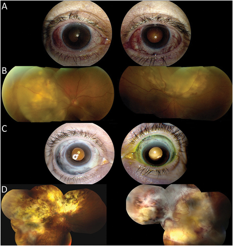 Figure 2. 63-year-old Caucasian female presenting with bilateral necrotizing anterior scleritis and panuveitis. A) Slit lamp photos demonstrating necrotizing anterior scleritis. B) Fundus photos demonstrating posterior scleritis with exudative retinal detachments C) Slit lamp photo showing bilateral scleromalacia post-immunosuppressive therapy. D) fundus photos showing bilateral chorioretinal scarring with fibrosis.