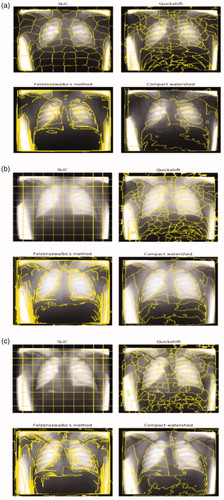 Figure 3. Comparison of segmentation results using four superpixel segmentation algorithms (a) superpixels of the original image (b) shows the superpixels generated for GHE image and (c) shows the superpixel segments of CLAHE image. (a) Input image (b)superpixel segmentation (c) GHE (d) CLAHE.