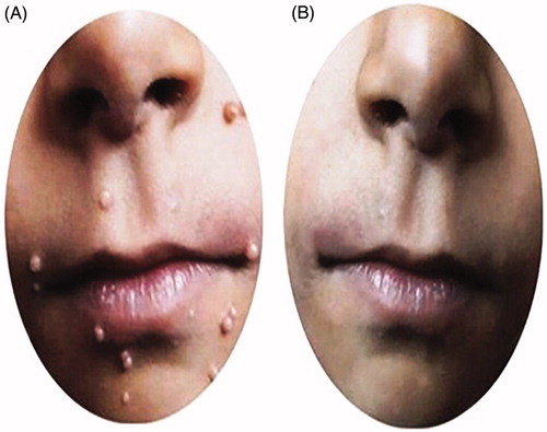 Figure 2. A case of MC showing complete response after five intralesional injections of PPD.