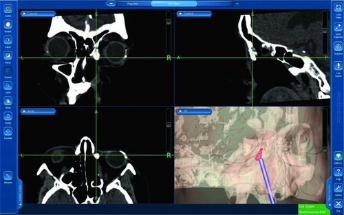 Figure 3 Case 1: Intraoperative image-guided view depicting the image-guided dacryolocalization using the 3D-reconstructed virtual model of the DCG (lower right panel).