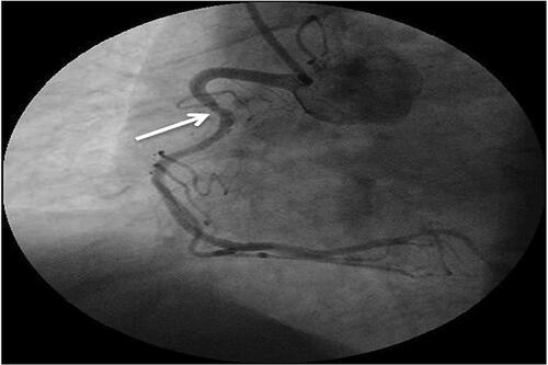 Figure 6 Conventional coronary angiography showing a right coronary angiogram. The left anterior oblique view showed mild atherosclerosis of the right coronary artery (RCA) (arrow shows the stenotic segment).