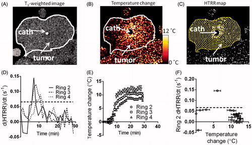 Figure 5. Conversion of temperature change (PRFS) to absolute temperature. (A) A T1-weighted image of the tumour prior to heating and Mn-LTSL injection. The catheter is labelled and the tumour outlined in white. (B) A temperature change map 5 min after initiation of heating. (C) A HTRR map of the tumour 5 min after initiation of heating. The annular ROIs used to analyse the data are superimposed. The innermost ring is ring 1 and the ring number increases as the rings move outwards. (D) A plot of the rate of change of HTRR (d(HTRR)/dt) in rings 2–4 as a function of time. (E) A plot of temperature change as a function of time, in the same rings as in C. (F) The rate of HTRR increase plotted as a function of temperature change. The data point above the dotted threshold line was used for calculating ΔTcal and calibration of the MRI temperature maps.