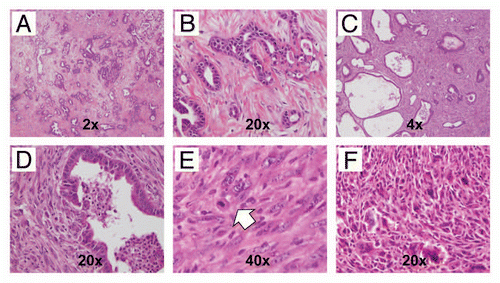 Figure 7 Variable histopathological features of PDAC arising in CBP mice. (A) Primary PDAC with extensive stromal desmoplasia, resembling the cognate human disease is observed in this CBP mouse (H&E stain, 2× magnification). (B) At higher magnification, infiltrating neoplastic glands in a bed of desmoplastic stroma can be seen (H&E stain, 20× magnification). (C) An example of a biphasic tumors with both adenocarcinoma and sarcomatoid components (H&E stain, 4× magnification). (D) At higher magnification of the tumor in (C), the confluence between the two components is highlighted (H&E stain, 20× magnification). (E) Higher magnification of the sarcomatoid carcinoma component also confirms the presence of atypical pleomorphic nuclei and mitotic figures (arrow) (H&E stain, 40× magnification). (F) An anaplastic carcinoma with prominent giant cells arising in a CBP mouse (H&E stain, 20× magnification).