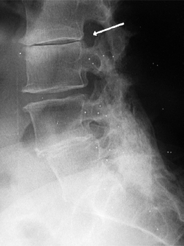 The same patient 5 years after fusion, with progressive degeneration of the L2–L3 level, where the disc is almost obliterated.