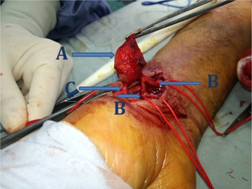 Figure 3 Intraoperative image showing A – aneurysm, B – radial artery, and C – proximal part of the superficial palmar arch.