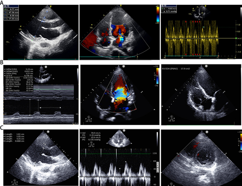 Figure 2 The transthoracic echocardiography (TTE). (A) TTE on April 13th revealed severely impaired movement of the ventricular wall (left ventricular end diastolic diameter (LVEDD), 47.3 mm; interventricular septum thickness (IVS), 8.4 mm; left ventricular ejection fraction (LVEF), 35.7%; left ventricular fraction shortening (LVFS), 17.1%; stroke volume, 37.1 mL), moderate to severe regurgitation of the mitral valve and tricuspid valve (the estimated pulmonary artery systolic blood pressure was 49 mmHg) and deteriorated diastolic function (E/E′, 9.1) as well as a moderately reduced right ventricular function [tricuspid annular plane systolic excursion (TAPSE), 12 mm]. The inferior vena cava was widened (inferior vena cava diameter, 22.3 mm]) and its’ respiratory collapse rate was less than 50%. (B) TTE on April 14th still showed decreased myocardial contractility (LVEDD, 51.9 mm; IVS, 8.0 mm; LVEF, 36.6%; LVFS, 17.7%; stroke volume, 47.3 mL), severe regurgitation of the mitral valve and deteriorated diastolic function (E/A, 3.3; E/E′, 21.5) as well as a moderately reduced right ventricular function. The respiratory collapse rate of inferior vena cava (diameter, 17.2 mm) was less than 50%. (C) TTE on April 21th revealed a normalized cardiac function (LVEDD, 42.5 mm; IVS, 10.5 mm; LVEF, 50.8%; LVFS, 30.3%; stroke volume, 46.9 mL), moderate regurgitation of the mitral valve and restored diastolic function (E/A, 1.8; E/E′, 9.7) without reduced right ventricular function.