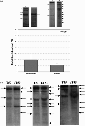 Figure 4. (a) Total protein glutathionylation in tumor and the corresponding non-tumor uroepithelial samples of TCC. Representative western blots of glutathionylated proteins are shown (arrows indicating bands of glutathionlylated proteins). The values of densitometric analysis are presented as mean ± SD and the data analyzed by the t-test (graph). Lane T (tumor tissue), lane nT (non-tumor tissue). Lane 1 (left), sample prepared in non-reducing conditions; lane 2 (right), sample treated with DTT presents negative control. (b) Total protein glutathionylation in tumor and the corresponding non-tumor uroepithelial samples of TCC. Representative western blots with anti-glutathione antibody for the purpose of visualizing glutathionylated proteins are shown with arrows indicating bands of glutathionlylated proteins.