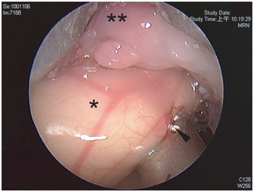 Figure 4 Epiglottic cyst*, lingual tonsil area**, arrow shows cutting edge of blade.