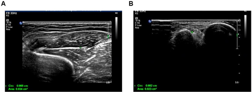 Figure 3 Nerve ultrasonic images. (A and B) Respective images for the nerve ultrasonic examination.