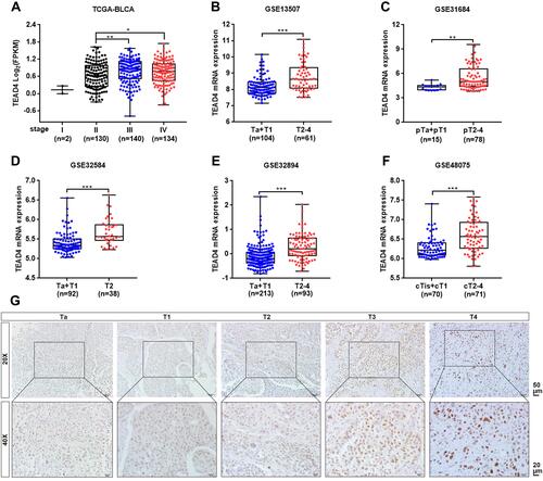 Figure 2 TEAD4 expression is elevated in advanced stage patients with UBC. (A–F) TEAD4 mRNA expression level in different tumor stage phase of UBC samples from TCGA-BLCA (A), GSE13507 (B), GSE31684 (C), GSE32584 (D), GSE32894 (E), and GSE48075 (F) datasets. (G) Representative IHC staining images of the TEAD4 expression in different tumor stage phase of UBC patients were displayed. Scale bar, 50 and 20μm. *P<0.05, **P<0.01, ***P<0.001.