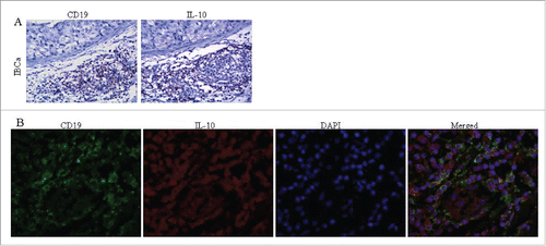Figure 2. The colocalization of CD19 and IL-10 expression in IBCa tissues. The colocalization of CD19 and IL-10 expression in IBCa were analyzed by immunohistochemistry and immunoflurescence staining as described in “Materials and Methods”, shown in Fig. 2 are representative microphotographs (× 400). (A) The immunohistochemistry staining of serial sections showed the location of CD19 expression as well as IL-10 in TILs of IBCa tissue. (B) Confocal Laser-Scanning Microscopy was applied to detect CD19 and IL-10 in IBCa specimens. Membrane of B cells was visualized by CD19 staining (Green), cytoplasm are stained with IL-10 (Red), and nuclei are counterstained with DAPI (Blue). Merged figure exhibit a colocalization of CD19 and IL-10 in the B cells.