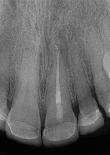 Figure 29. 2nd view of 6mo follow up and complete apical healing.