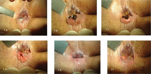 Figure 1 All six photos are taken from the same patient. In three-day intervals, they show the healing of a perforated and bleeding single thrombosed external hemorrhoid within nine days of a patient who consequently complied to our strict conservative management policy. A) Day 0: The patient is in knee–chest position, head left. Right-lateral of the anus parts of the uninflamed external hemorrhoidal plexus are protruding. Left-lateral there is edematous tissue with a dark spot (nonperforated thrombosed external hemorrhoid) with a subcutaneous clot. B) Day 3: Perforation and anal bleeding occurred in between. Right-lateral of the anus parts of an unaltered external hemorrhoidal plexus are seen. Left-lateral redness and edema of inflamed anal skin perforated by two black clots. C) Day 6: The right-lateral parts of the external hemorrhoidal plexus remain unchanged. The left-lateral clots are still at same position. D) Day 6: Both clots were taken out. A gaping lesion remains at former perforation site. E) Day 9: A 2–4 mm healing lesion is seen at former perforation site. At right-lateral, unchanged parts of the external hemorrhoidal plexus. F) Day 32: At follow-up four weeks later, the left-lateral perforation can hardly be seen. At right-lateral, the uninflamed subcutaneous external hemorrhoidal plexus appears unchanged.