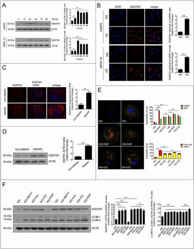 Figure 2. Autophagy is inhibited by HG in RPE cells during DR. (a) After exposure to HG for 0, 12, 24, 48, 72, and 96 h, HsRPE and ARPE-19 cells were subjected to western blot analysis using the indicated antibodies (SQSTM1 and ACTB). ACTB was used as a protein loading control. Representative images from three independent experiments with biological and technical replicates are shown, n = 6. (b) Immunofluorescence staining of SQSTM1 showing quantitative changes in HsRPE and ARPE-19 cells after exposure to NG or HG for 24 h. Representative images from three independent experiments with biological and technical replicates are shown. Scale bars: 20 μm, n = 6. (c) The RPE cells of non-diabetic and diabetic rats were flat-mounted and stained for SQSTM1. The pictures were taken on the upper retina 100 μm away from the optic nerve. Representative images from three independent experiments with biological and technical replicates are shown. Scale bars: 10 μm, n = 10. (d) Western blot analysis was performed to quantify the levels of SQSTM1 in the retinas of non-diabetic and diabetic rats (all the non-diabetic and STZ-induced diabetic rats were fed with a regular diet). Representative images from three independent experiments with biological and technical replicates are shown, n = 10. (e) Fluorescent microscopic analysis of ARPE-19 cells transfected with plasmid constructs harboring LC3B fused with a tandem mRFP-GFP tag (tfLC3B) and treated with NG, NG+rapamycin (RAP, 1 μM), NG+chloroquine (CQ, 30 μM), HG, HG+rapamycin (RAP, 1 μM), or HG+chloroquine (CQ, 30 μM) for 24 h. The yellow puncta indicate autophagosomes. The free red puncta indicate autolysosomes. Representative images from three independent experiments with biological and technical replicates are shown. Scale bars: 10 μm, n = 6. (f) Western blot analysis of LC3B and SQSTM1. The difference in LC3B-II and SQSTM1 levels between ARPE-19 cell samples with or without bafilomycin A1 (Baf A1, 50 nM), leupeptin (LEU, 10 μm), chloroquine (CQ, 30 μM), and rapamycin (RAP, 1 μM) was compared after exposure to NG or HG for 24 h. Representative images from three independent experiments with biological and technical replicates are shown, n = 6. #P > 0.05; *P < 0.05; **P < 0.01; *** P < 0.001.