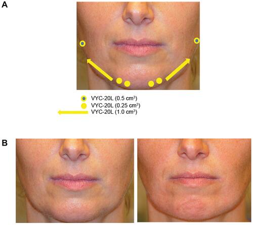 Figure 4 Masculinization of the jawline with repeated VYC-20L injections in a 42-year-old female-to-male transgender patient. (A) Colored dots and arrows indicate injection points with corresponding concentrations of filler injected. (B) The patient before (left) and 4 months after (right) treatment. Patient images provided by Koenraad De Boulle, MD.