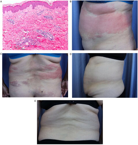 Figure 1. Histopathological pattern of leukocytoclasia without vasculitis. (A) Microscopic observation of leukocytoclasia without vasculitis. Evolution of SchS before and after canakinumab treatment. (B) Skin wounds before canakinumab treatment (side view). (C) Skin wounds before canakinumab treatment (dorsal view). (D) Skin recovery after one dose of canakinumab (side view). (E) Skin recovery after one dose of canakinumab (dorsal view).