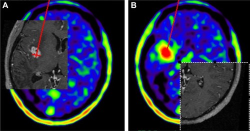 Figure 6 18F-FET PET-guided stereotactic serial biopsy of an insular lesion.