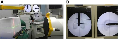 Figure 3 The femoral model was firmly fixed in the blind box (A). Ensured that the Kirschner wire (Φ=2mm) was drilled along the red and green laser lines and confirmed that the Kirschner wire passed through the nail hole through fluoroscopy (B).