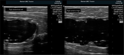 Figure 1 Ultrasound image showing two simulated subcutaneous abscess cavities (4 cm total depth).