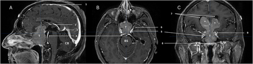 Figure 2 (A) Sagittal (B) Axial (C) Coronal; Neuro-Navigation Guided Magnetic Resonance Images depicting the large pituitary tumour with suprasellar extension through the third ventricle into both lateral ventricles causing significant mass effect and impending hydrocephalus (volume of 36.081 cm3). T: Tumour; CB: Cerebellum; BS: Brainstem; 1: Superior sagittal sinus; 2: Internal cerebral vein; 3: Vein of Galen; 4: Basilar artery; 5: Internal carotid arteries; 6: Left medial temporal lobe; 7: Lateral ventricles; 8: Floor of the sella turcica largely obliterated by the tumour extending into the sphenoid sinus; 9: Left cavernous sinus.