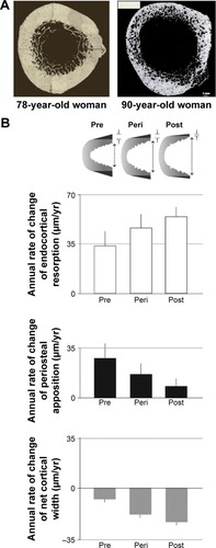 Figure 2 Postmenopausal changes in bone architecture.