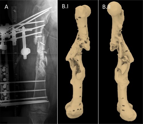 Figure 5. Femoral bone defect (A) AP view X-ray of the defect (adapted from Laubach et al. [Citation1]) (B) 3D model of the defect following segmentation.