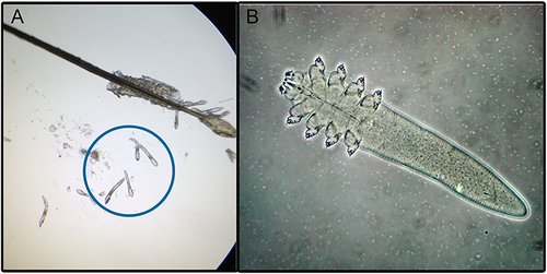 Figure 1 Microscopic views of Demodex mites. (A) Multiple Demodex mites on and around a lash. (B) Highly magnified Demodex mite.