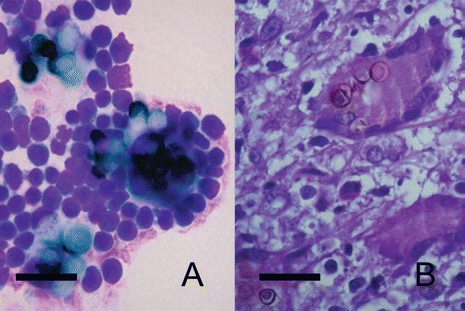Figure 2 In vitro-generated sclerotic cells can stimulate the formation of Langhans giant cells in vitro. Langhans giant cells are observed 24 hours after interaction with balb/c mice peritoneal macrophages (A). Morphologically similar giant cells are present in the histopathology of lesional skin (B). Scale bars: 50 µm.