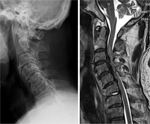 Figure 3 Sigmoid type of cervical kyphosis.