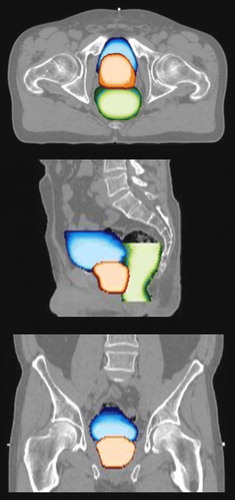 Figure 2.  Illustration of the spatial probability distribution of the prostate (orange), rectum (green) and bladder (blue) taken over the fractionated treatment. Bright colors indicate a high probability. The top, middle and lower image correspond to the axial, sagittal and coronal plane, respectively.