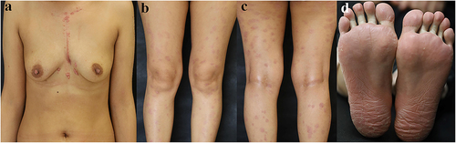 Figure 2 SAPHO syndrome patient with after-treatment skin lesions. (a-d) Erythema, papules, and pustules gradually subsided, leaving slight pigmentation.