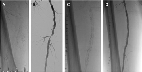 Figure 2 Moderately calcified right SFA (A) with severe stenosis in the middle segment (digital subtraction angiography) (B) treated with a 5.5×150 mm Supera stent (C) with no significant residual stenosis (D).