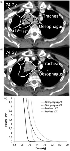 Figure 3. Overdosage of oesophagus (D1cm3 > 70 Gy) and trachea (D1cm3 > 74 Gy) due to tumour shrinkage between pCT (a) and sCT (b). The corresponding DVH’s for the oesophagus and trachea on pCT (full line) and sCT (dashed line) (c).