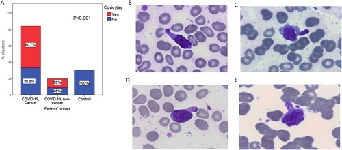 Figure 2. (A) Assessment of the Covicytes in patients’ groups. (B–E) Atypical lymphocytes with clumpy chromatin and basophilic cytoplasm with large granular tail (Covicytes), 100× magnification.