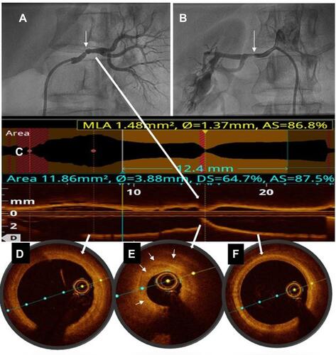 Figure 2 Current bilateral renal angiogram showing significant restenosis (arrows) in the left (A) and right (B) renal arteries. Longitudinal reconstruction of optical coherence tomography (OCT) imaging (C) of left renal artery depicting the corresponding lesion indicated by white arrows. Cross-sectional images showing distal (D) and proximal (F) reference zones are free of disease and measure 4.2mm. The area of focal restenosis on the angiogram correlate with extensive medial and intimal hyperplasia (arrows) on OCT (E), causing 87% area (re) stenosis.