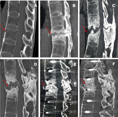 Figure 1 CT images showed “bamboo-like changes” in the spine, and T12 showed a fresh three-column fracture (red arrow) (A) A pseudarthrosis with marked sclerosis at T12, and the upper part of the T12 vertebral body was damaged irregularly (red arrow) (B) The lesion involved the intervertebral space and the lower part of the T11 vertebral body, with pseudarthrosis and obvious hyperplasia (red arrow) (C) The scope of the lesions had extended, with severe thoracolumbar kyphosis and spinal canal stenosis (red arrow) (D) The position of the pedicle screw was well fixed, the kyphosis was obviously corrected, and the intervertebral bone graft was adequate (red arrow) (E) AL segmental bone grafts have good fusion (red arrow) (F).