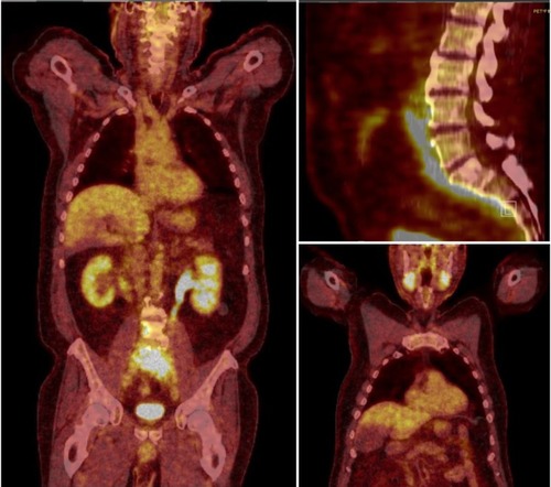 Figure 1 PET/CT scan of a patient later histologically diagnosed with a retroperitoneal diffuse large B-cell lymphoma, whereas upon biopsy, the enhancement in the submandibular glands turned out to be IgG4-related sialadenitis.