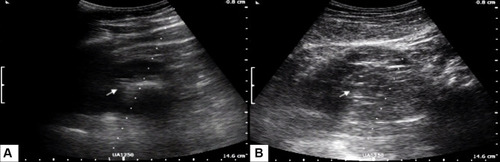 Figure 4 (A) Appearance of ureteral catheter (arrow) in collecting system during insertion; (B) Water jet appearance (arrow) when normal saline was flushed from the ureteral catheter.