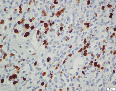 Figure 4 Immunohistochemistry staining for Ki67 (glioblastomareccurent) showed high expression.