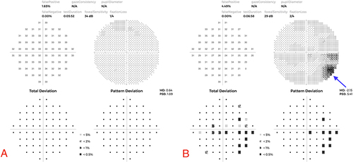 Figure 4 (A) 10–2 Visual field (VF): OD mild scattered VF depression. (B) 10–2 Visual field (VF): OS mild scattered VF depression and temporal scotoma in the left eye. Arrow pointing to a wedge-shaped scotoma.