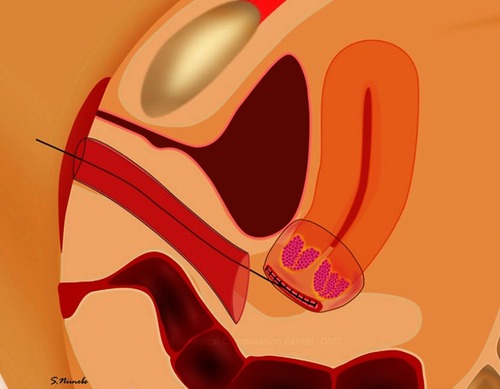 Figure 3 Vaginal closure at laparoscopic radical hysterectomy.Note: The vaginal cuff on the uterus side was closed by running sutures with 0 bicryl; the uterine cervix with the tumor was covered with the vaginal wall to avoid spilling the tumor cells.