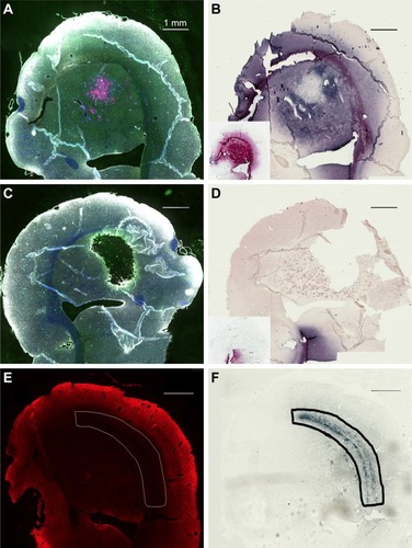 Figure 6 Directly injected AuNPs are found in the white matter track and peritumor region but not in the main tumor region.Notes: (A) Left hemisphere, fluorescence; (B) left hemisphere containing a brain tumor, gold enhanced; (B, inset) left hemisphere with no brain tumor, gold enhanced; (C) right hemisphere, fluorescence; (D) right hemisphere, gold enhanced; (D, inset) right hemisphere with no brain tumor; and (E) another animal, left hemisphere, stained for neurons (anti-Tuj 1, red fluorescence). (A and C) mCherry red (tumor, red), anti-albumin (edema, green), DAPI (nuclei, blue), and anti-CD31 (blood vessels, white) and (B, D, and F) gold enhanced (gold stained, black).Abbreviations: AuNPs, gold nanoparticles; CD31, cluster of differentiation 31.