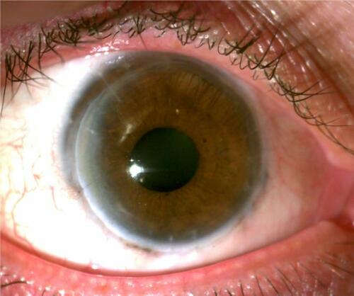 Figure 1 Right eye of the patient at nearly eighteen months following penetrating keratoplasty. Courtesy of Dr.Ryan T Barrett file photo.